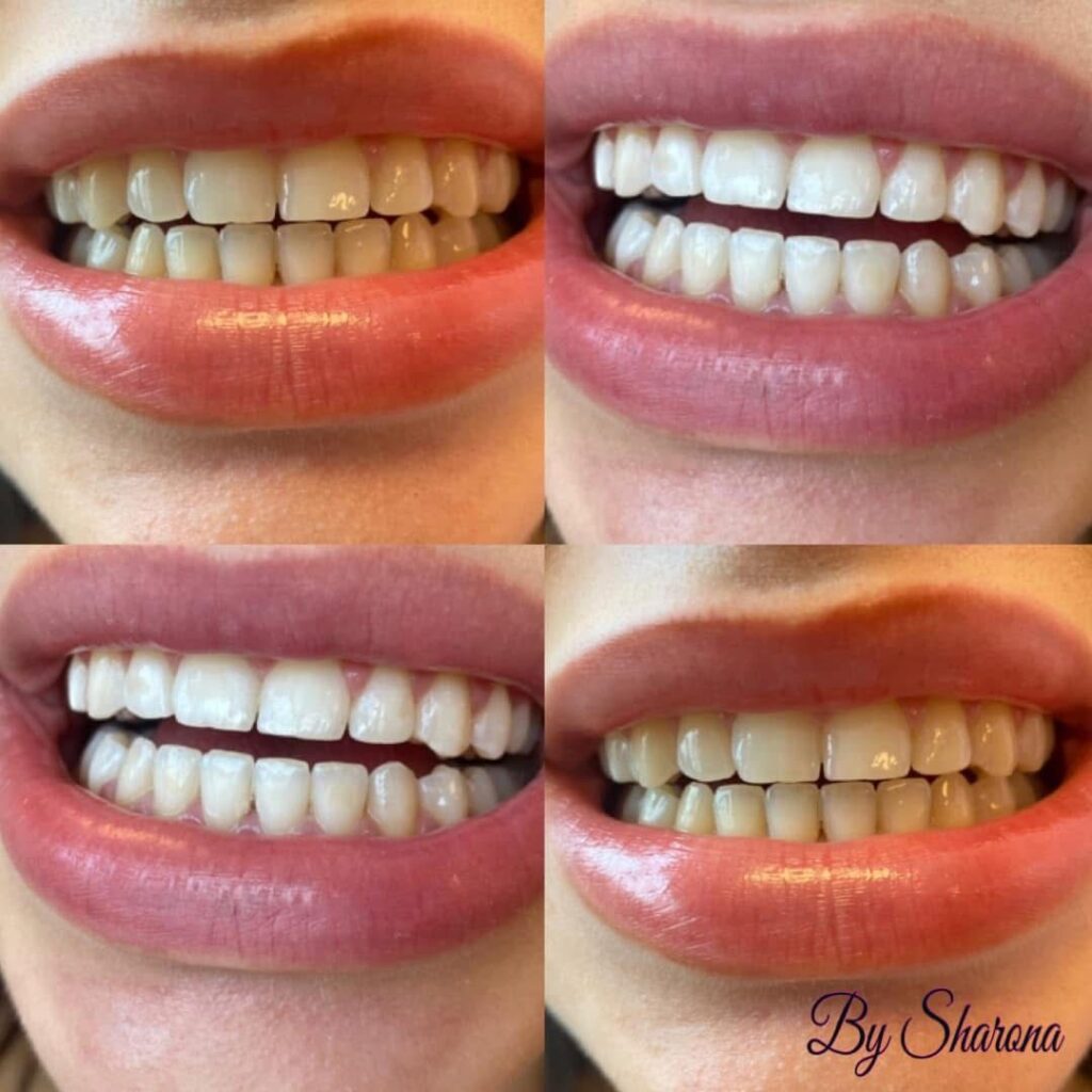 Voor en na foto van een klant met duidelijke resultaten na de behandeling tanden bleken.